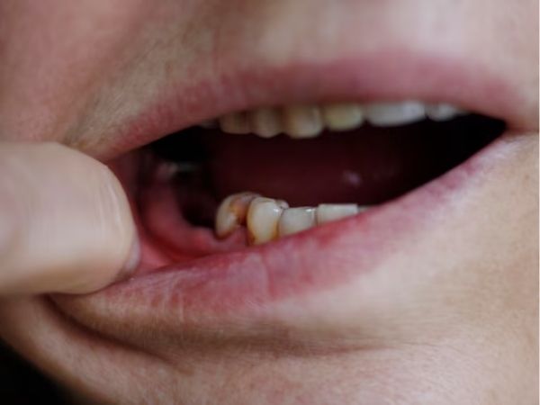 Os Efeitos Do Uso De Cocaína e Crack Na Arcada Dentária